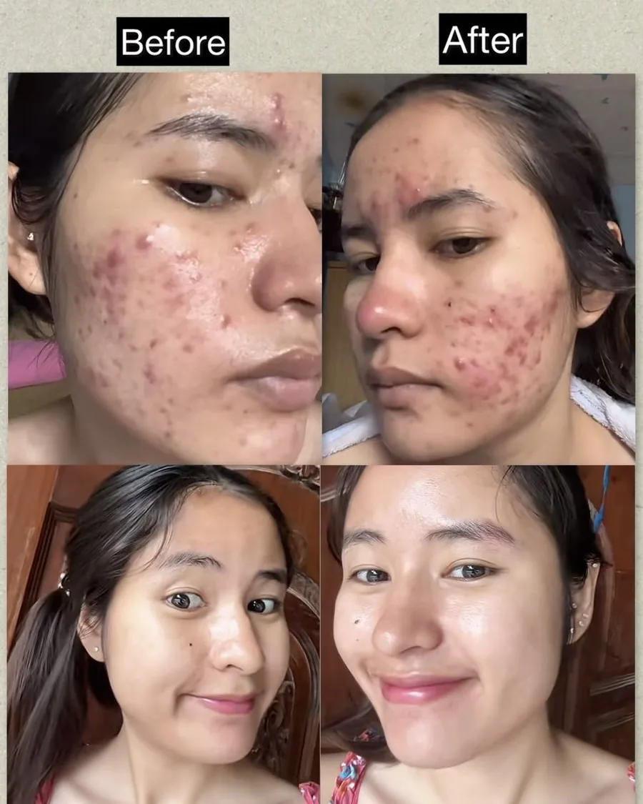 Testimoni before after CARECOAL 9
